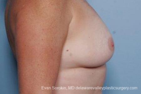 Philadelphia Breast Augmentation 9316 - Before Image 3