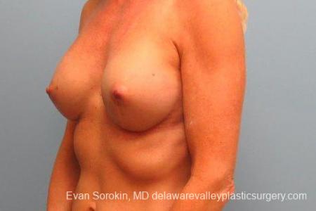 Philadelphia Breast Augmentation 9415 - After Image 4