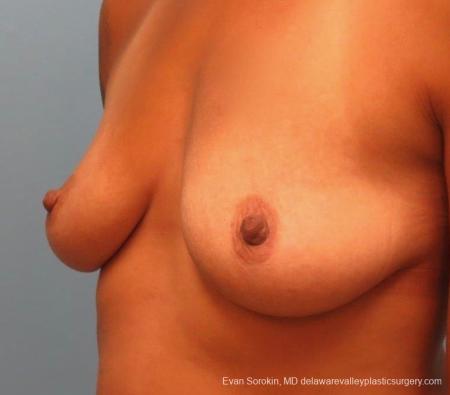 Philadelphia Breast Lift and Augmentation 8824 - Before 3
