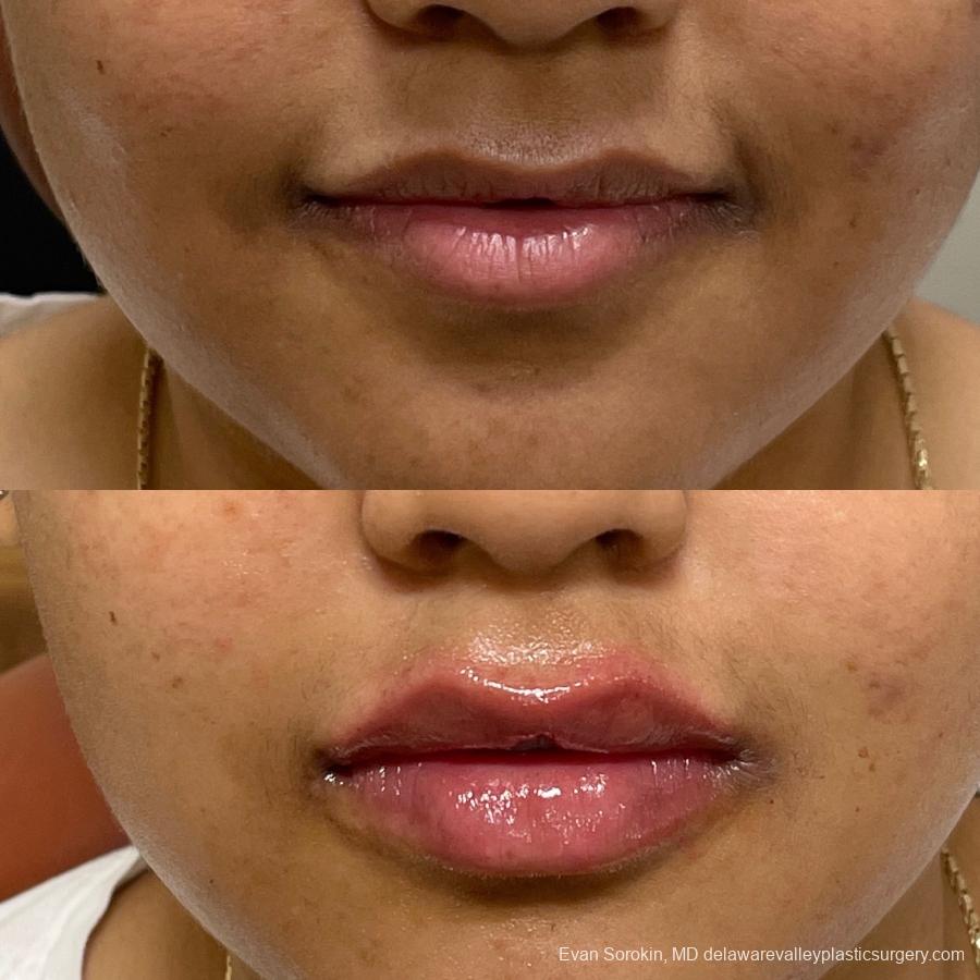 Lip Augmentation: Patient 23 - Before and After 1