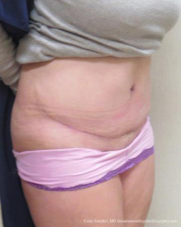 Philadelphia Abdominoplasty 9267 - After Image 2