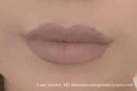 Lip Filler: Patient 19 - After Image 2