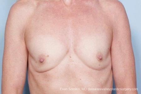 Philadelphia Breast Augmentation 8770 - Before Image 1