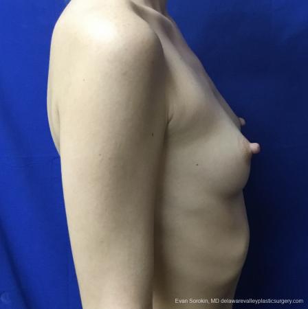 Breast Augmentation: Patient 166 - Before Image 3
