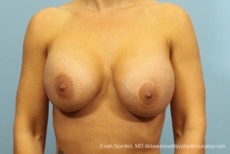 Philadelphia Breast Lift and Augmentation 8710 - Before Image 1
