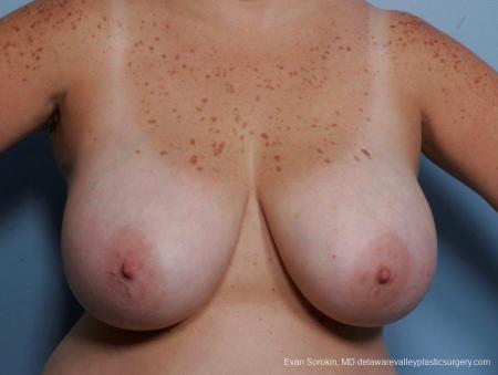 Philadelphia Breast Reduction 8703 - Before Image 1