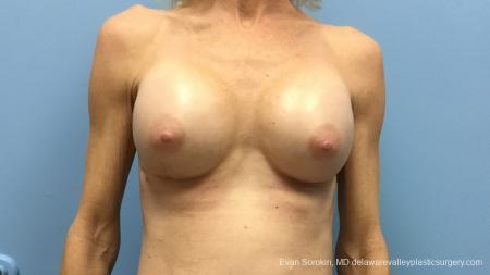 Philadelphia Breast Augmentation 13182 - After Image 1