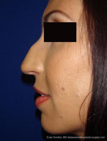 Rhinoplasty: Patient 1 - Before Image 1