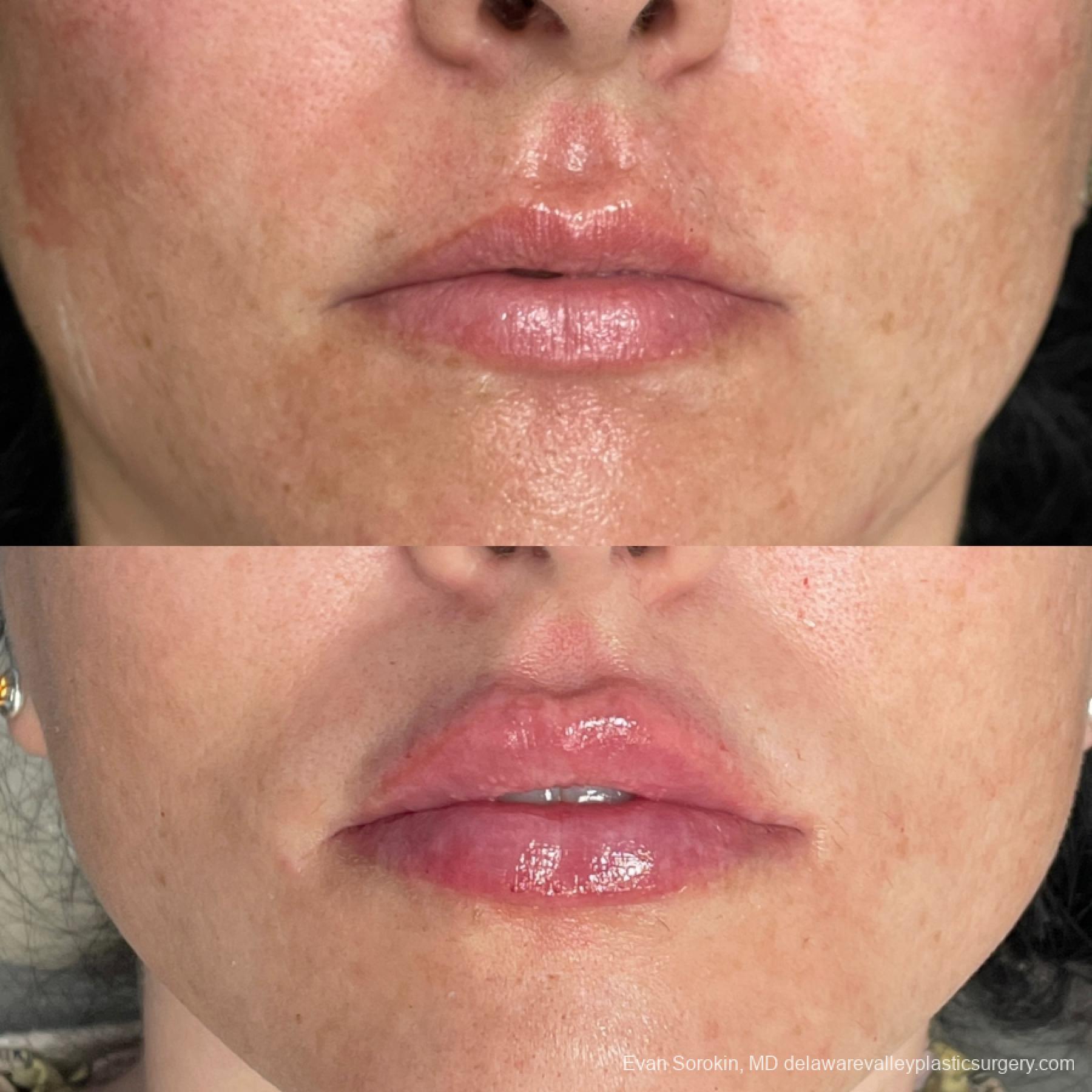 Lip Augmentation: Patient 64 - Before and After 1