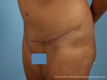 Philadelphia Abdominoplasty 9471 - After Image 4