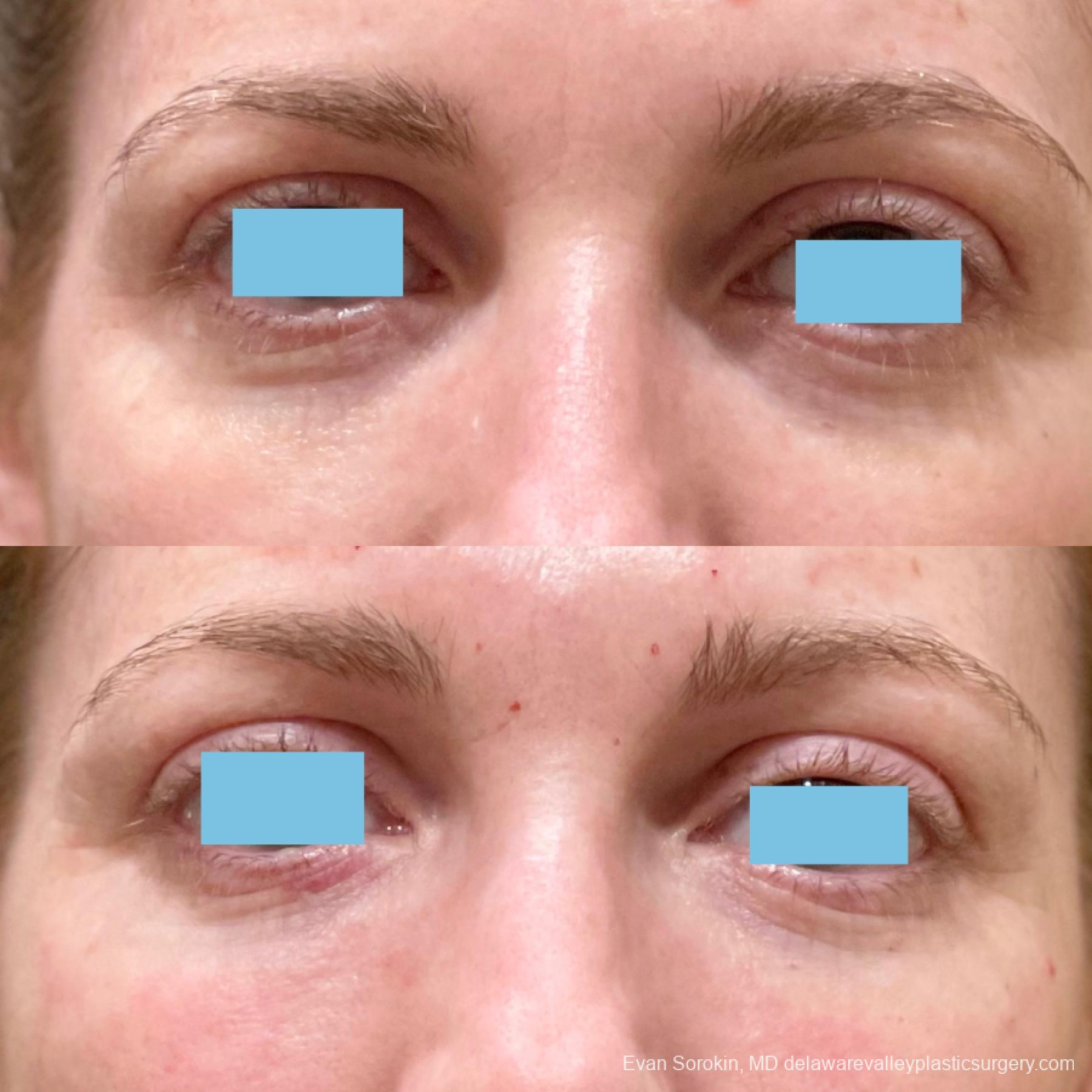 Fillers: Patient 15 - Before and After 
