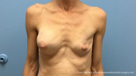 Philadelphia Breast Augmentation 13182 - Before Image 1