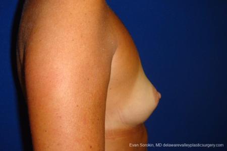 Philadelphia Breast Augmentation 8775 - Before and After Image 4
