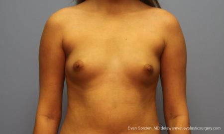Philadelphia Breast Augmentation 9194 - Before Image 1