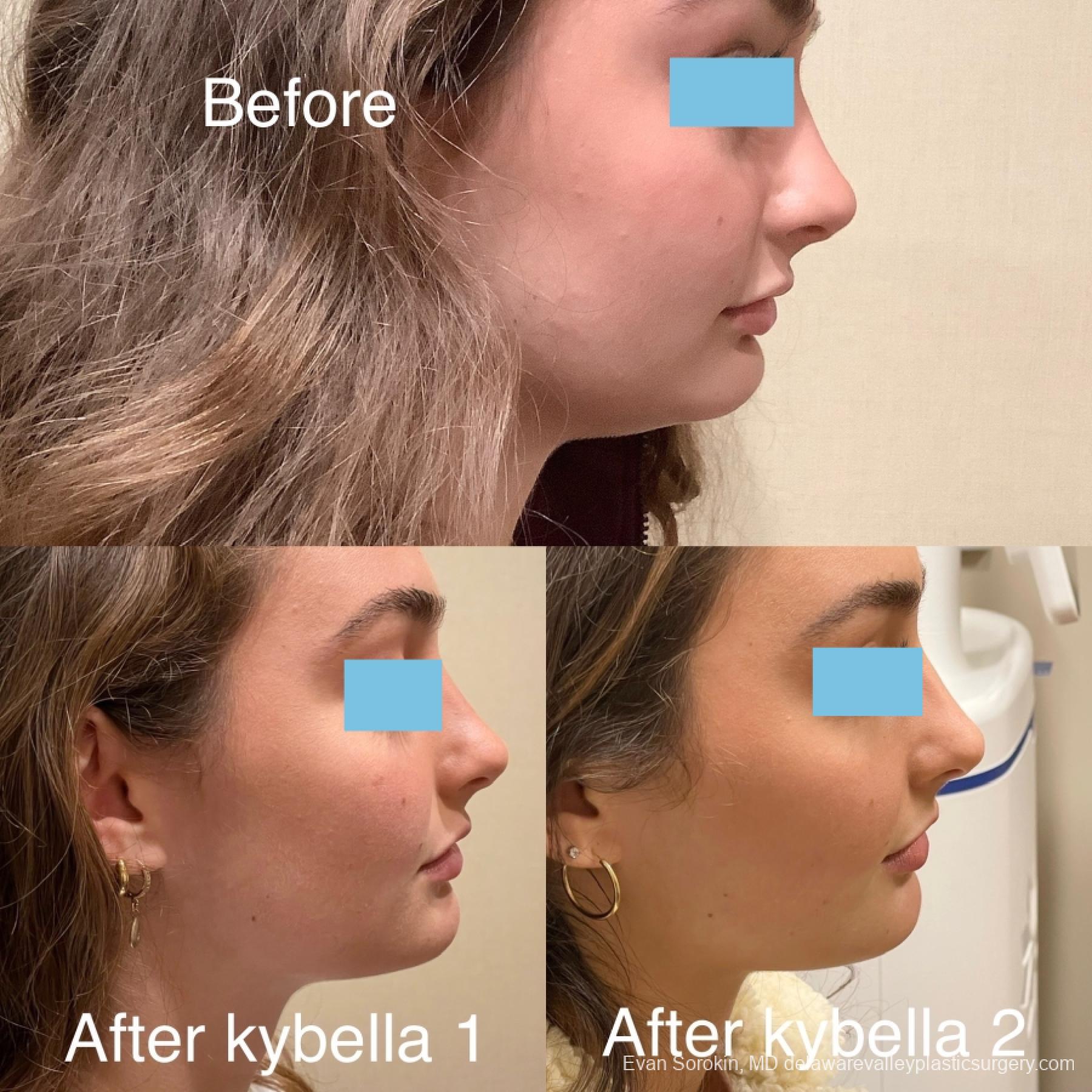 Kybella: Patient 1 - Before and After 2