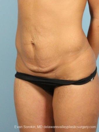 Philadelphia Abdominoplasty 8698 - Before Image 2