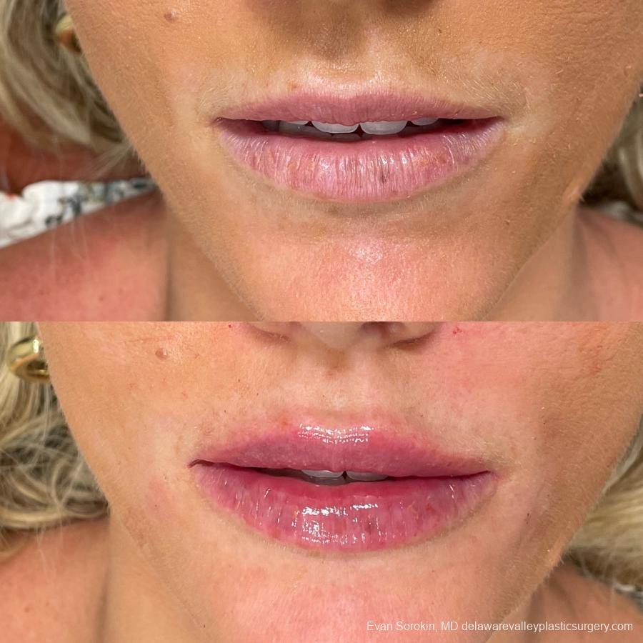Lip Filler: Patient 38 - Before and After 1