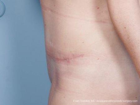 Philadelphia Abdominoplasty 9476 - After Image 5