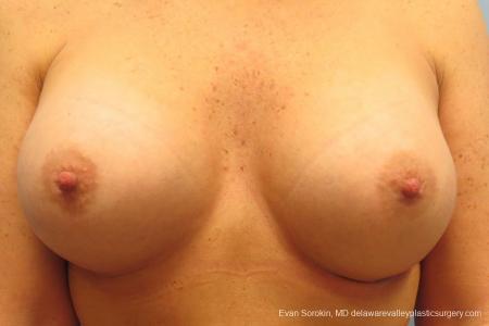 Philadelphia Breast Augmentation 9406 - After Image 1