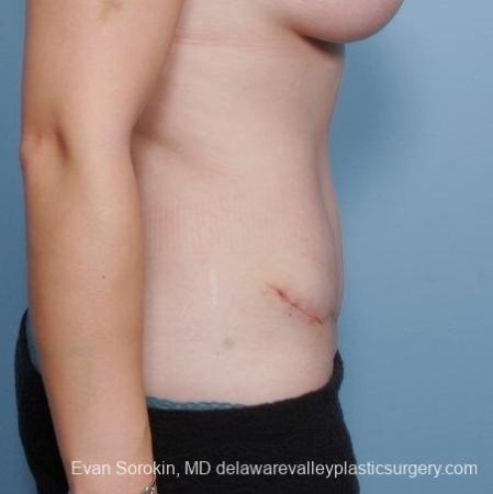 Philadelphia Abdominoplasty 8681 - After Image 4