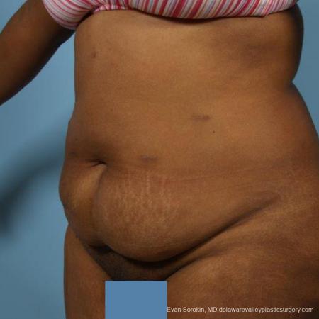 Philadelphia Abdominoplasty 9472 - Before and After Image 4