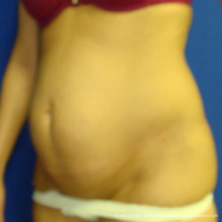 Philadelphia Abdominoplasty 9475 - Before Image 4