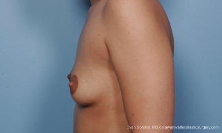 Philadelphia Breast Augmentation 9382 - Before and After Image 3