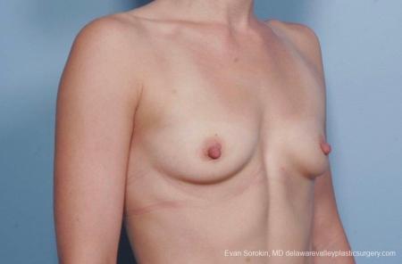 Philadelphia Breast Augmentation 8767 - Before Image 2