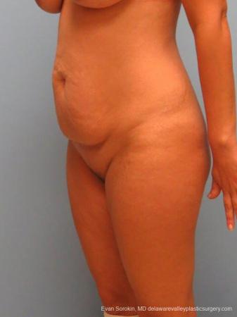 Philadelphia Abdominoplasty 9460 - Before Image 4