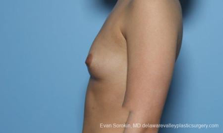 Philadelphia Breast Augmentation 8773 - Before and After Image 5