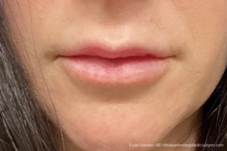 Lip Filler: Patient 13 - After Image 1