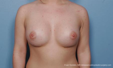 Philadelphia Breast Augmentation 9378 - After Image 1