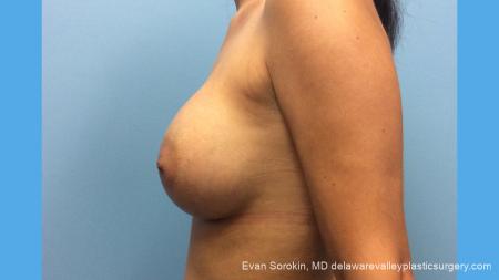 Breast Augmentation: Patient 137 - After Image 3