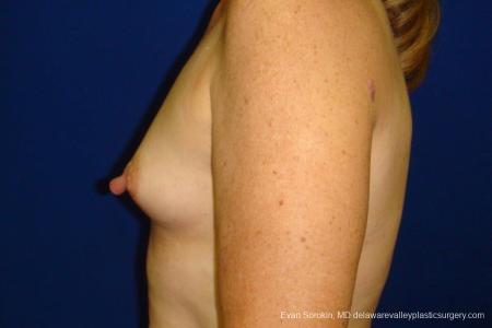 Philadelphia Breast Augmentation 8765 - Before and After Image 5