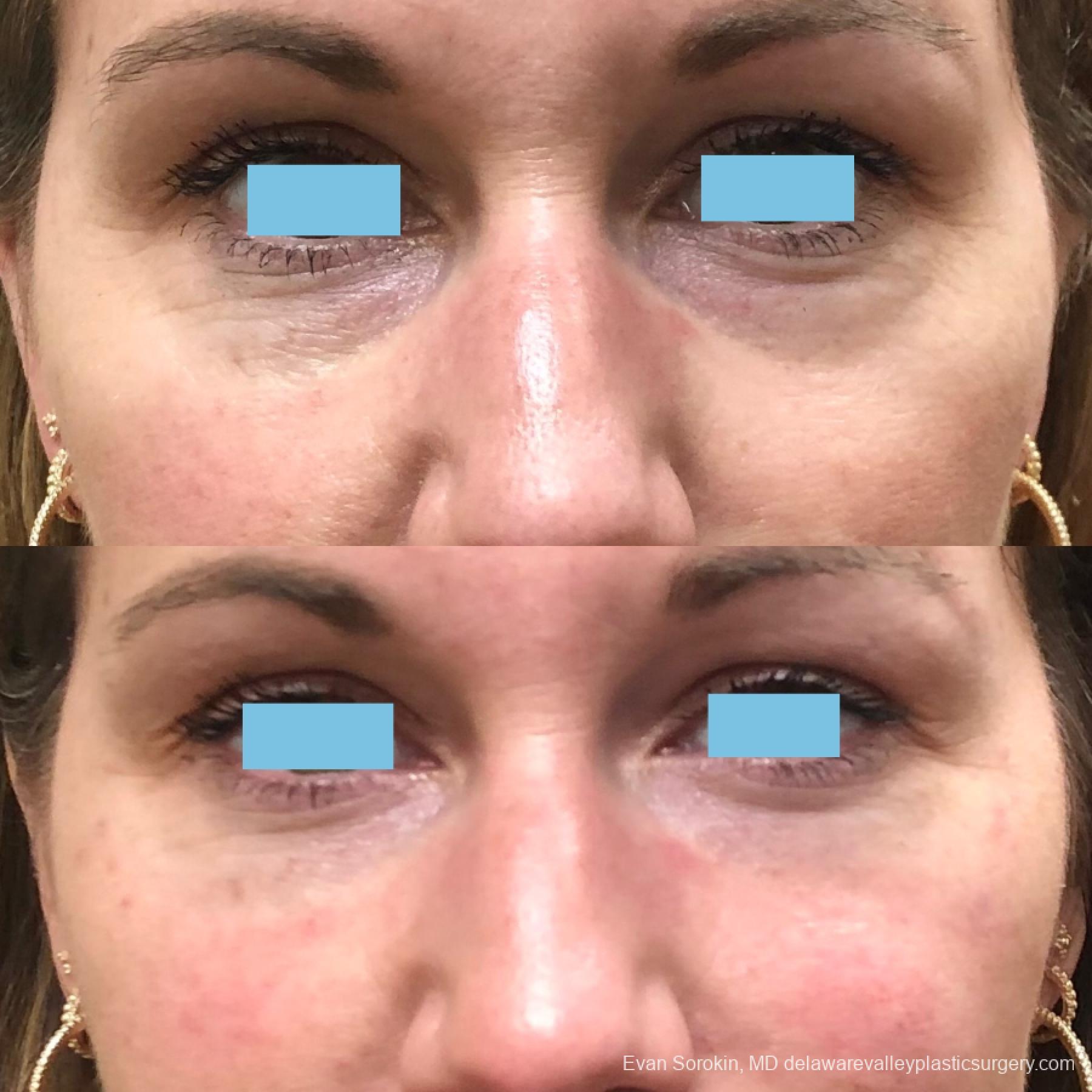 Fillers: Patient 9 - Before and After  