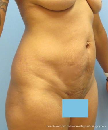 Philadelphia Abdominoplasty 8825 - Before Image 2