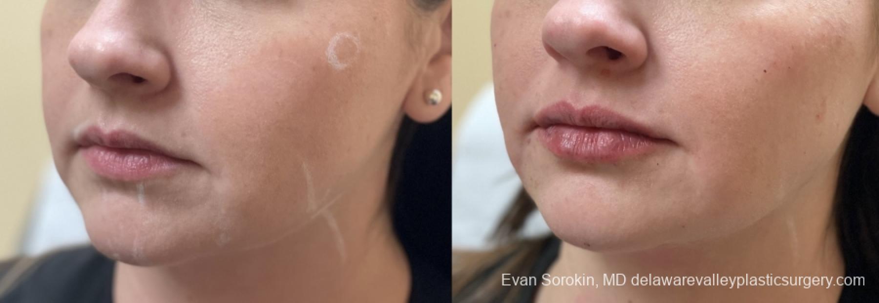 Lip Filler: Patient 49 - Before and After 3