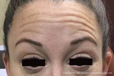 BOTOX® Cosmetic: Patient 3 - Before Image 1