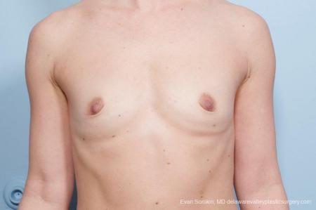 Philadelphia Breast Augmentation 8651 - Before Image 1