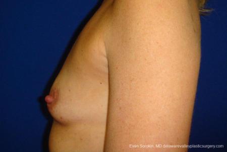 Philadelphia Breast Augmentation 9412 - Before and After Image 5