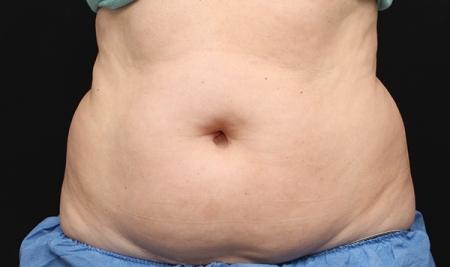 CoolSculpting®: Patient 2 - Before Image 1