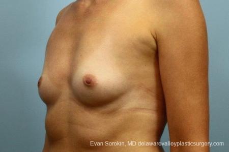 Philadelphia Breast Augmentation 8764 - Before Image 3