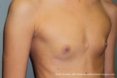 Philadelphia Breast Augmentation 8668 - Before Image 2