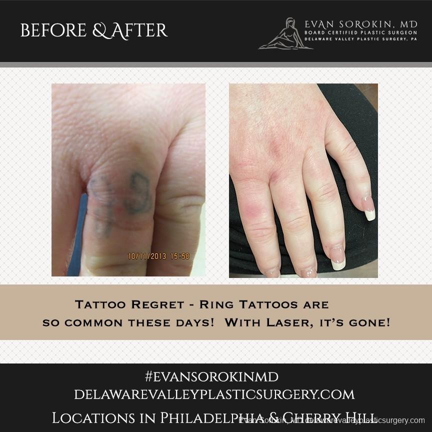 Tattoo Removal: Patient 8 - Before and After 1