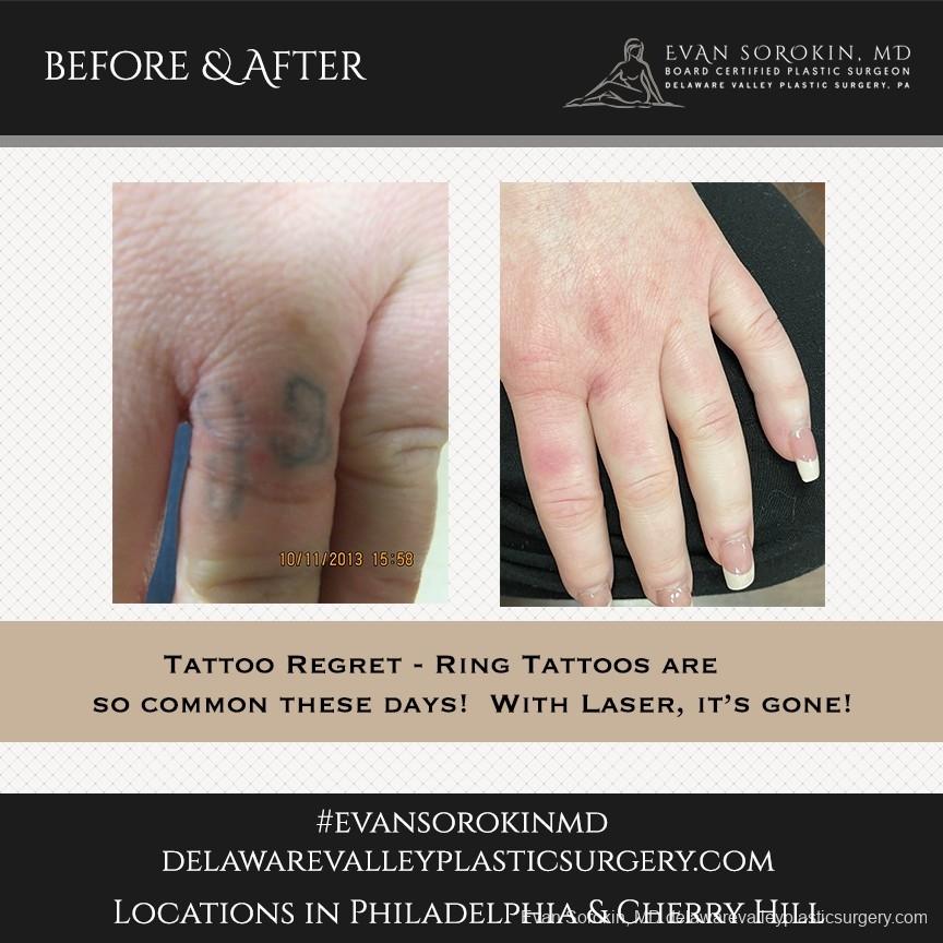 Tattoo Removal: Patient 8 - Before and After Image 1