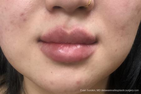 Lip Filler: Patient 15 - After Image 1