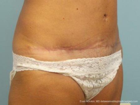 Philadelphia Abdominoplasty 9464 - After Image 2