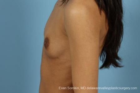 Philadelphia Breast Augmentation 9411 - Before and After Image 3