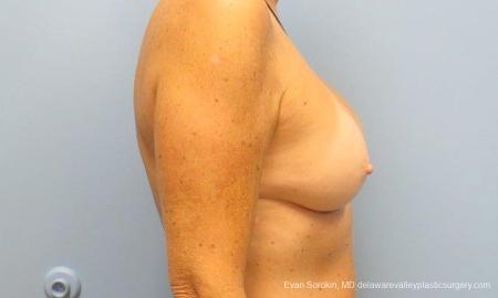 Philadelphia Breast Augmentation 9549 - After Image 3