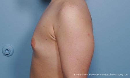 Philadelphia Breast Augmentation 9378 - Before and After Image 5